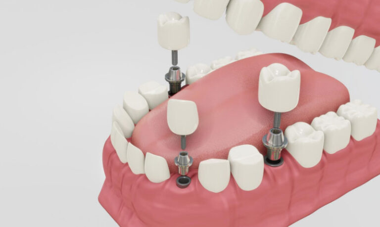 Smile Confidently: The Comprehensive Guide to Cutting-Edge Dental Implant Services