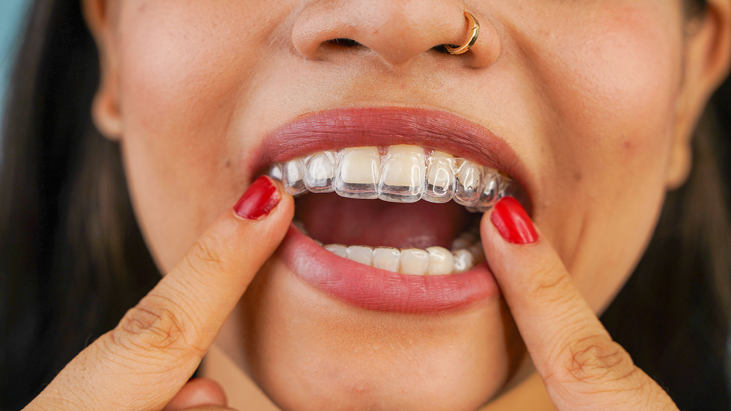 Invisalign's Influence on Boosting Professional Confidence in Meetings