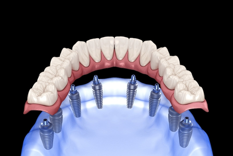 How Dental Implants Contribute to Improved Taste Perception and Enhanced Food Enjoyment